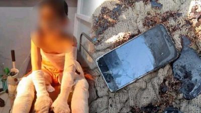 Main Handphone, Bocah Perempuan di Cidahu  Sukabumi Terbakar Hampir Sekujur Tubuh