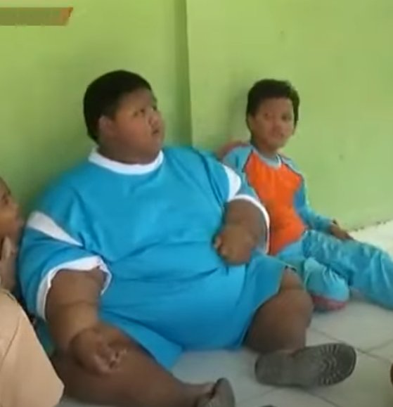 Masih Ingat Arya Permana Si Bocah Berbobot 192 Kilogram? Ini Kabarnya Sekarang