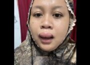 Bibir Calon Pengantin Bengkak Jelang Akad Nikah, Videonya Viral karena Santai dan Kocak