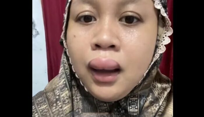 Bibir Calon Pengantin Bengkak Jelang Akad Nikah, Videonya Viral karena Santai dan Kocak