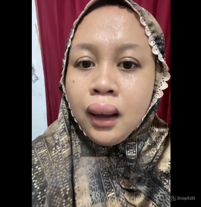 Bibir Calon Pengantin Bengkak Jelang Akad Nikah, Videonya Viral karena Santai dan Kocak