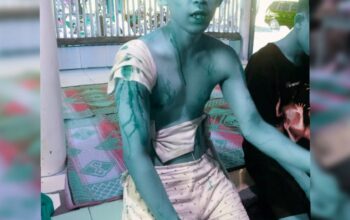 Dibacok Begal Saat Berkemah di Pantai Cibuaya, Korban Alami Luka Serius