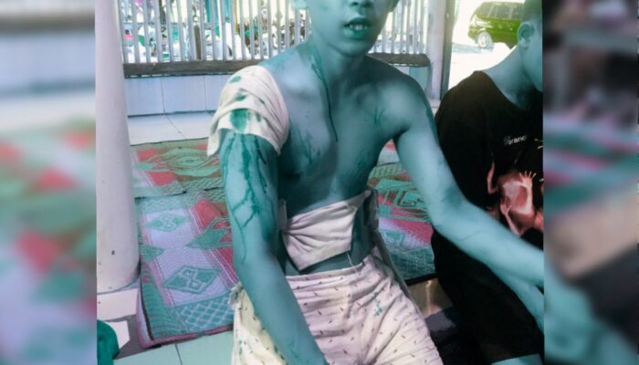 Dibacok Begal Saat Berkemah di Pantai Cibuaya, Korban Alami Luka Serius