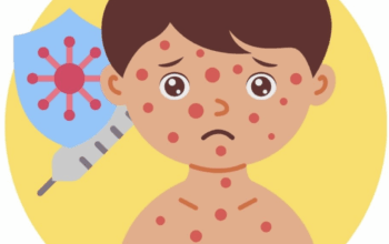 Waspada! 23 Kasus Campak Ditemukan di Kota Sukabumi