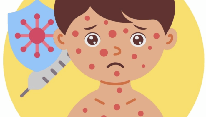 Waspada! 23 Kasus Campak Ditemukan di Kota Sukabumi