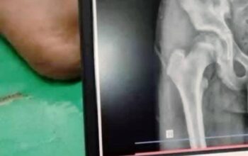 Tulang Panggul Retak, Siswa SMP Swasta di Nagrak Diduga Jadi Korban Perundungan