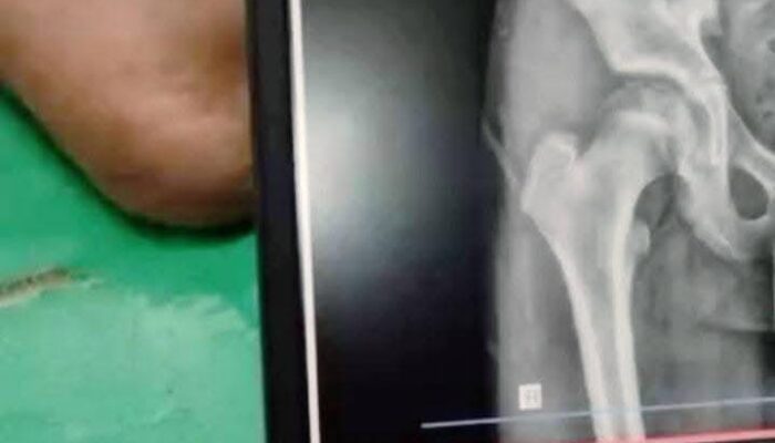 Tulang Panggul Retak, Siswa SMP Swasta di Nagrak Diduga Jadi Korban Perundungan