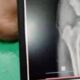 Tulang Panggul Retak, Siswa SMP Swasta di Nagrak Diduga Jadi Korban Perundungan